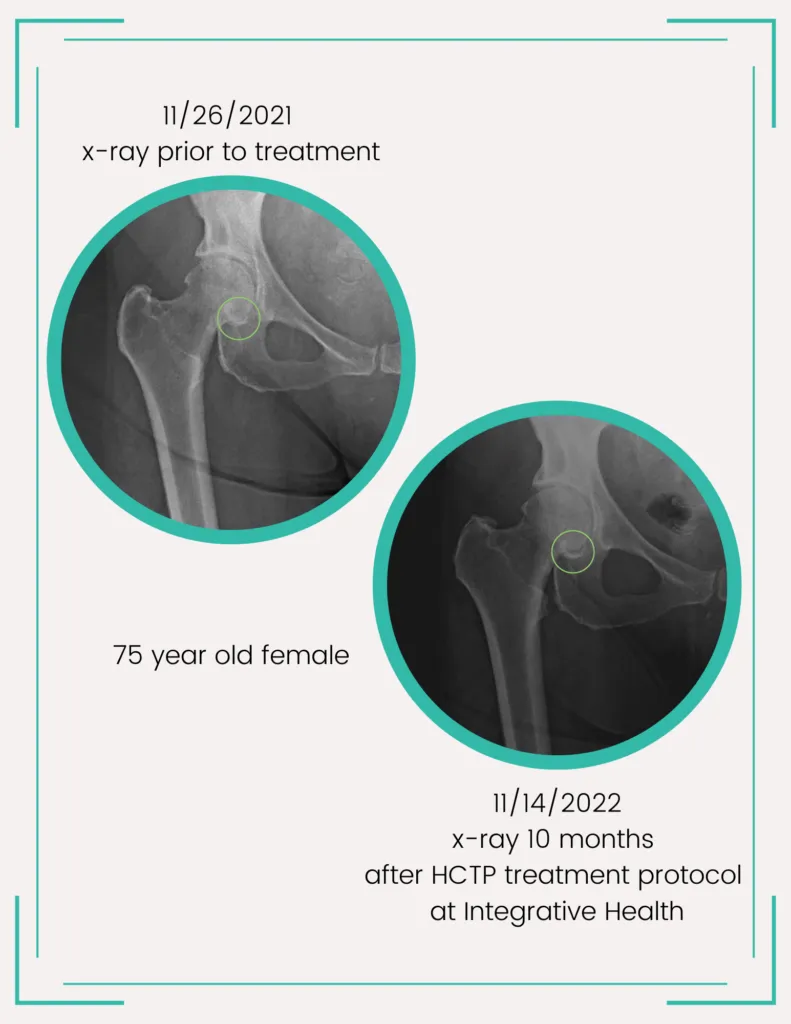 hip treatment results